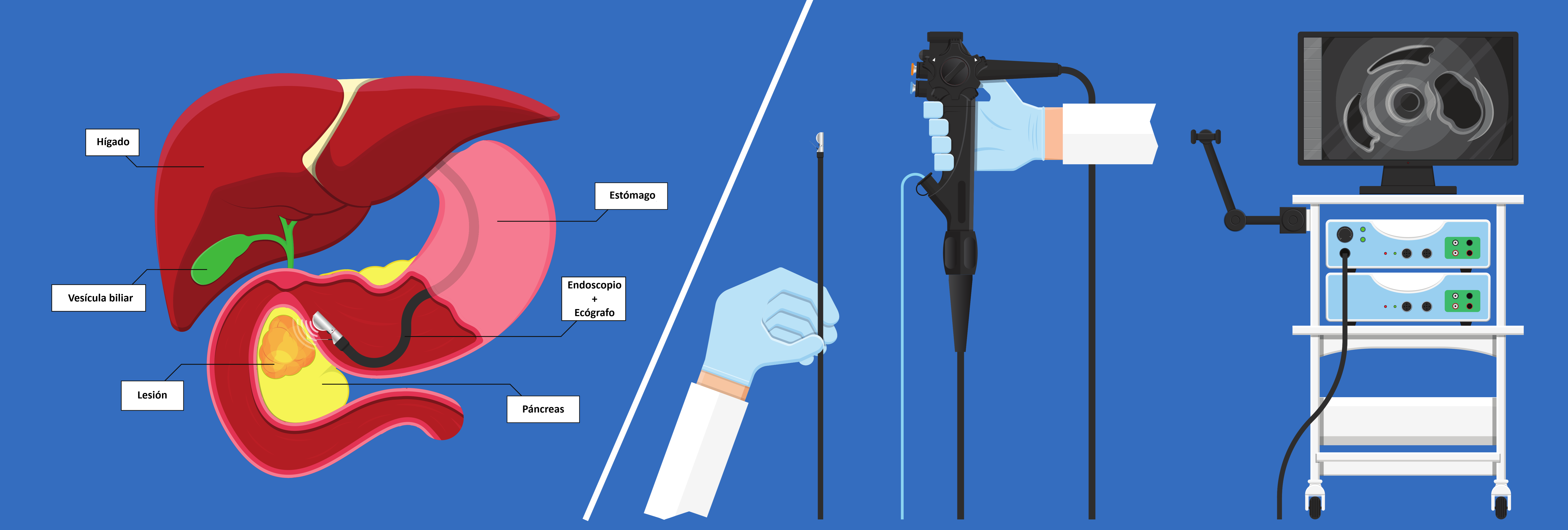 Ecografía endoluminal eco-endoscopia diagnóstica con punción