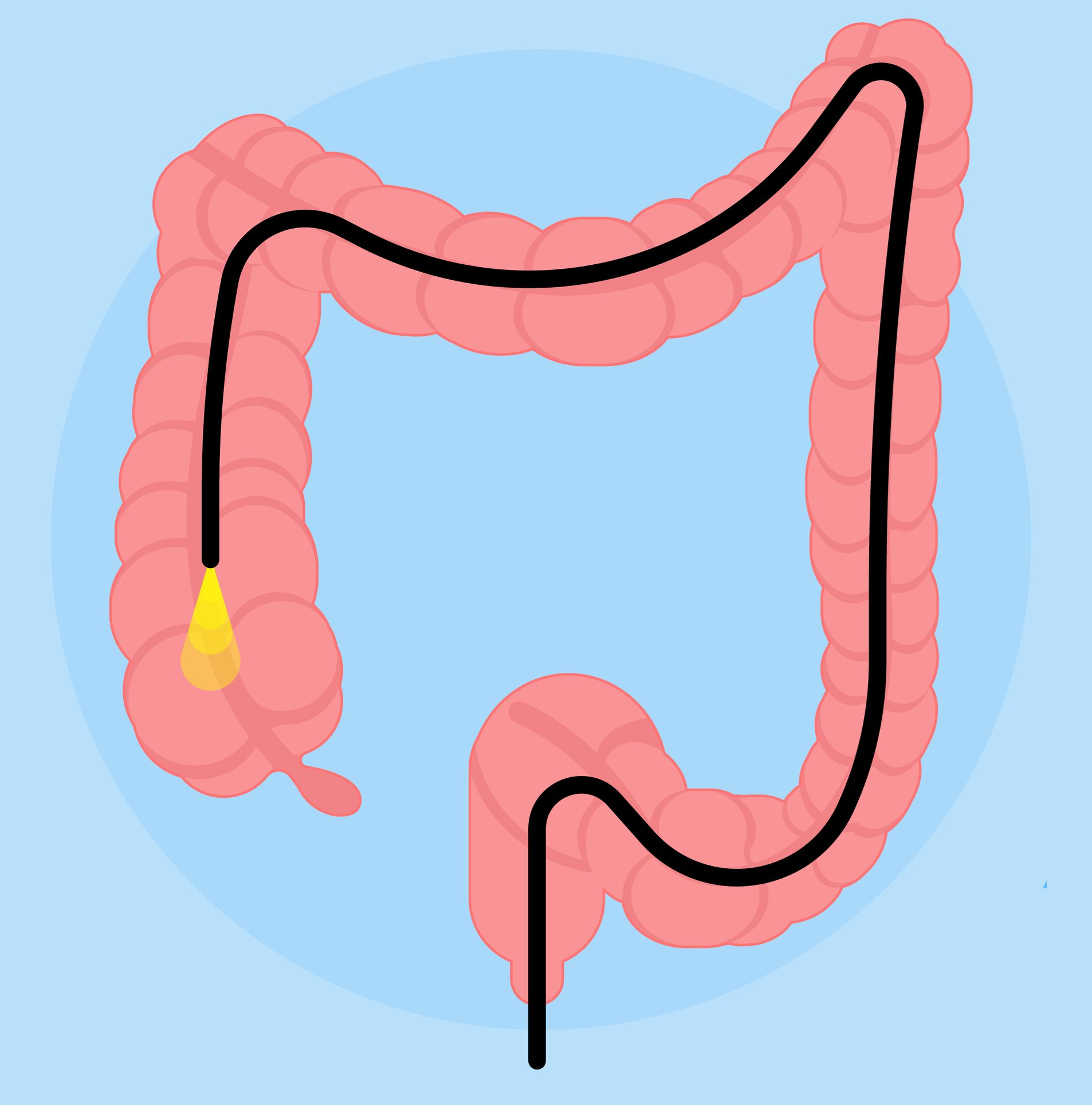Colonoscopia explicación